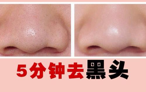 怎样解决草莓鼻？3招策略不能少